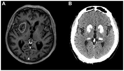 Secondary parkinsonism associated with focal brain lesions